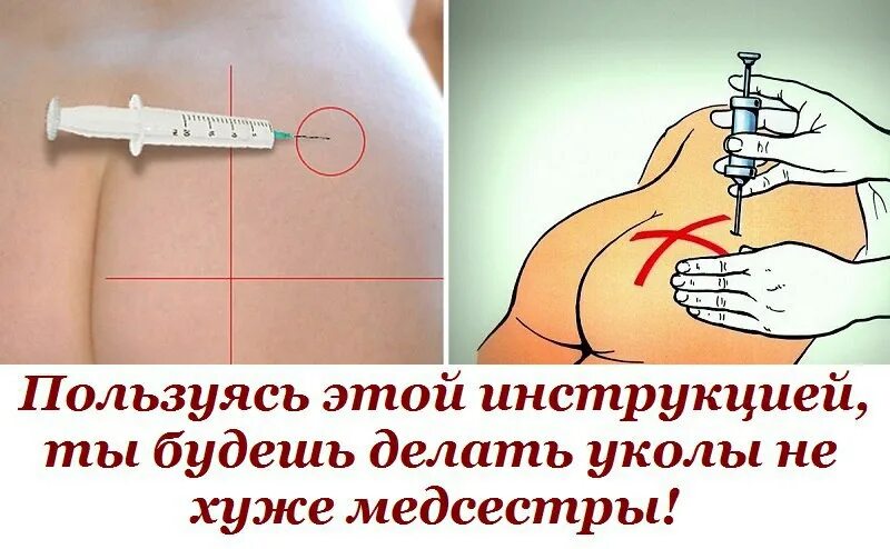 Можно ли внутривенное колоть внутримышечно. Как правильно ставить укол внутримышечно. как правильно ставить уколы внутримышечно в ягодицу. как ставить укол в ягодицу в домашних условиях взрослому. как правильно делать уколы в ягодицу в домашних условиях самому.