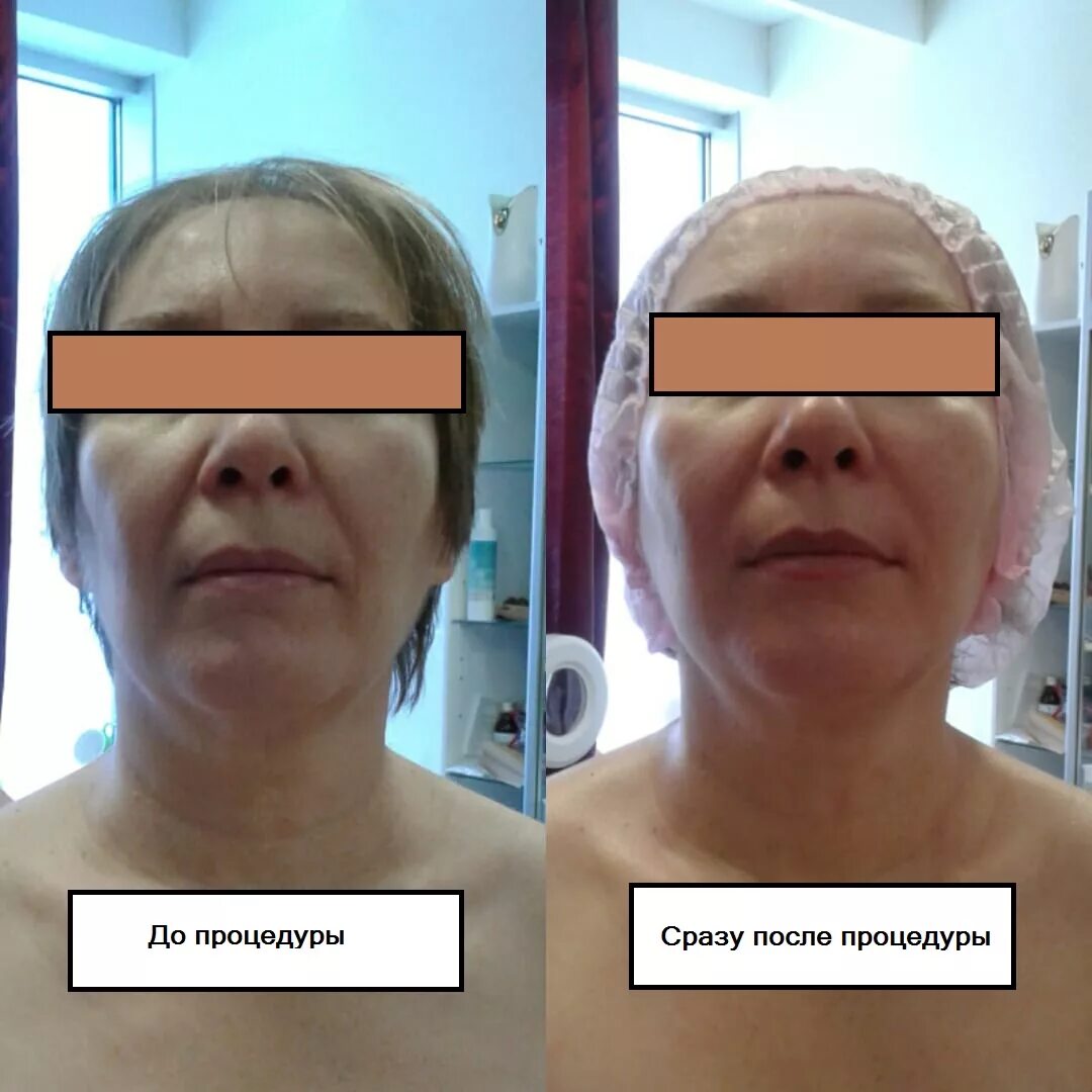 Моделирующий массаж лица до и после. Китайский скребковый массаж гуаша. Результаты гуаша. Гезатон скребок гуаша. Массаж гуаша до и после лицо.