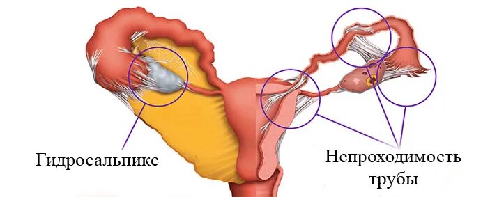 непроходимость маточных труб. эндометриозные спайки. гсг непроходимость маточных труб. проходимость маточных труб. бесплодие маточных труб.