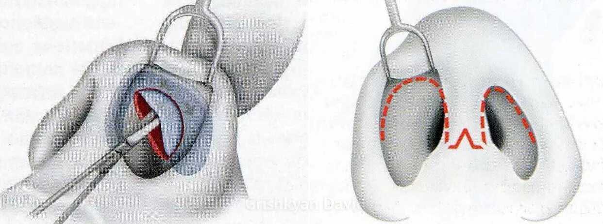 Операция по восстановлению перегородки. Закрытая ринопластика ход операции. Открытая и закрытая ринопластика. Открытая ринопластика операция. Хрящ носовой перегородки.