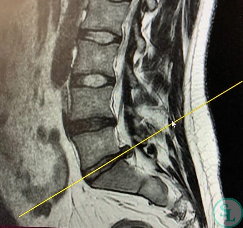Позвоночник отделы l5 s1. Грыжа диска l5-s1. Грыжа l5-s1 мрт. Протрузия МПД l5-s1. Грыжа межпозвонкового диска l5-s1.
