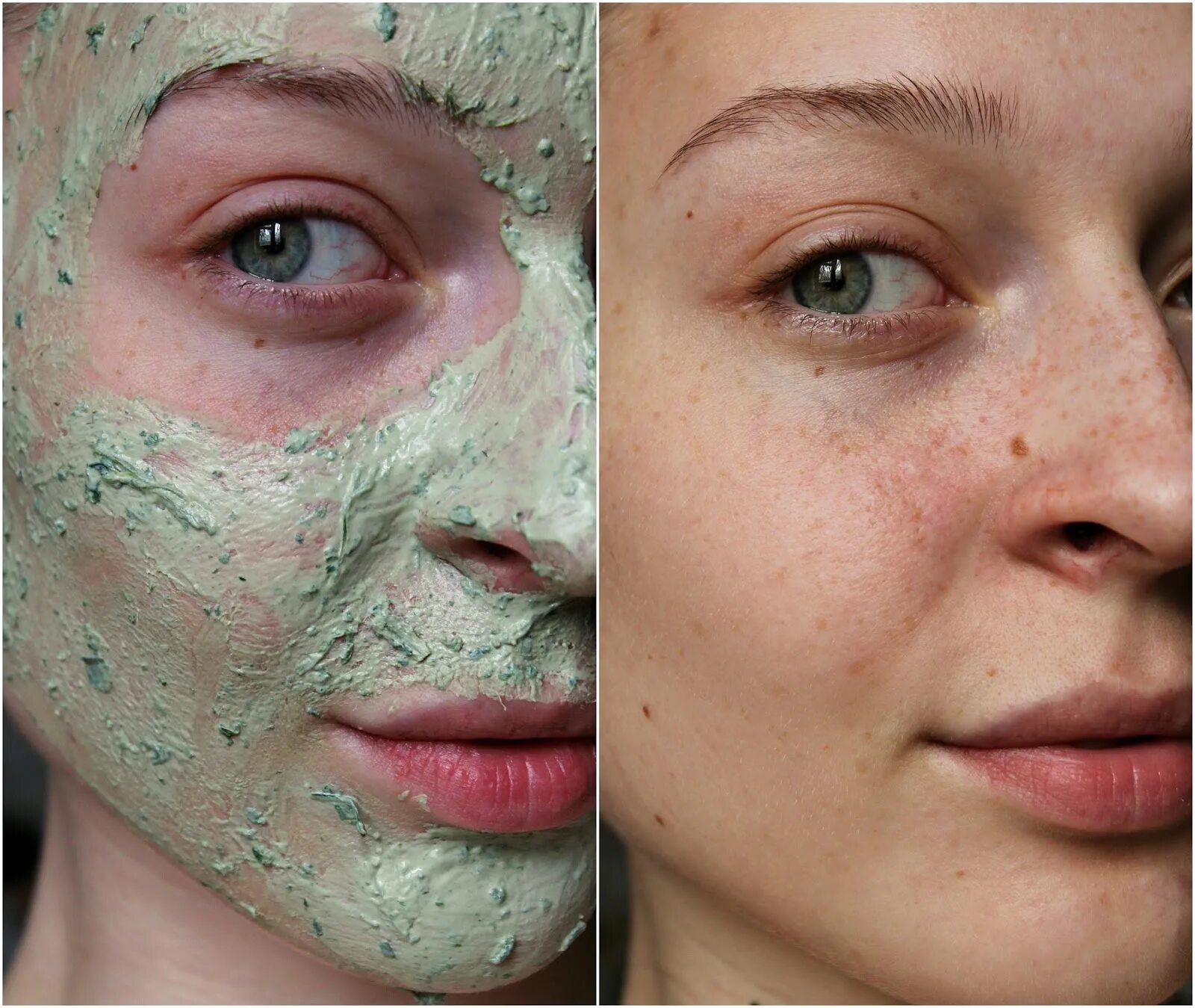 Бадяга отзывы до и после Характеристики модели GALAXYDERM Гель от постакне заживляющий, от ожогов, покрас
