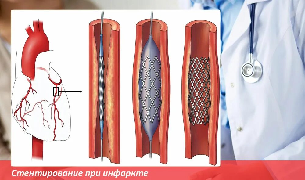 Терапия после стентирования