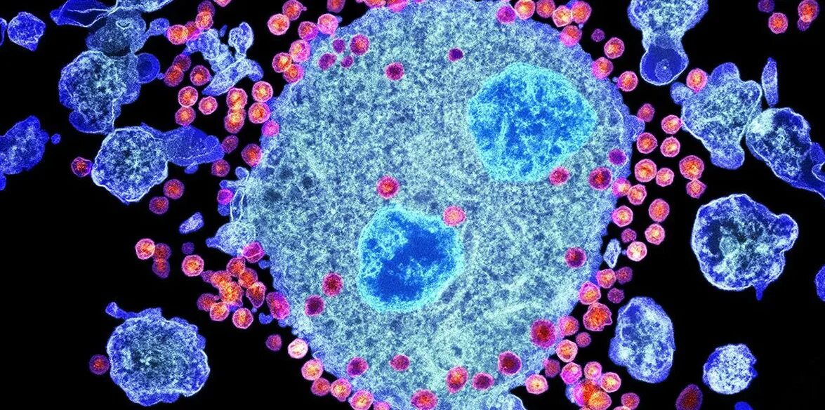 Т клеточный иммунодефицит. Вирус СПИДА под микроскопом. Клетка ВИЧ.