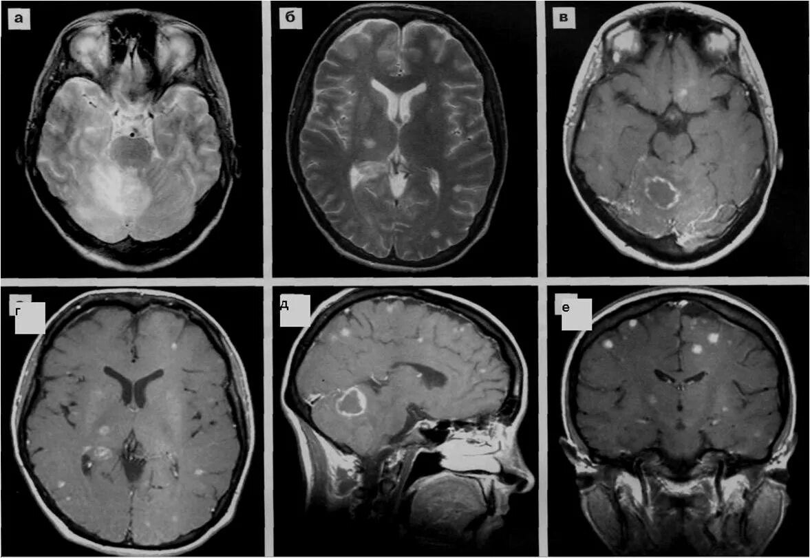 Т1 и т2 мрт. Опухоль головного мозга т1 т2. ВИЧ энцефалит мрт головного мозга. Многоочаговое поражение головного мозга