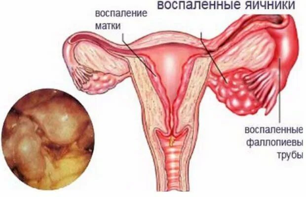 Сальпингоофорит (аднексит). Клинические проявления оофорита. Хронический острый оофорит. Хронический левосторонний оофорит. Оофорит что это.