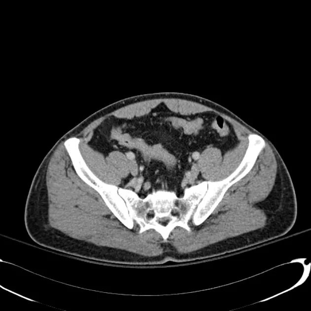 Кт органов таза у мужчин. Bony pelvis на кт. Кт ОМТ. Компьютерная томография (кт) малого таза. Малый таз кт.