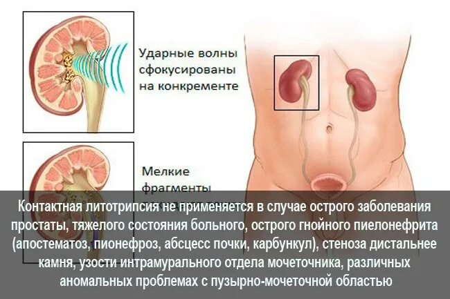 Почки держится температура. Контактная литотрипсия камней мочеточника. Контактная литотрипсия камней в почках. Дистанционная литотрипсия камней почек. Камни из почек операция.