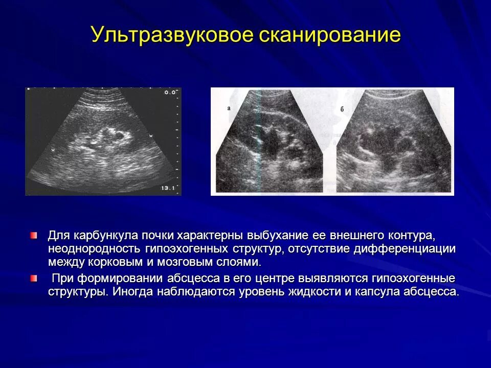 Жидкость при остром пиелонефрите. Абсцесс почки УЗИ картина. УЗИ почек острый пиелонефрит.