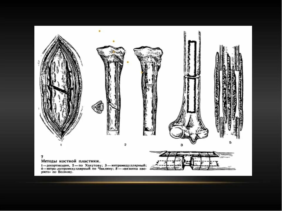 остеосинтез перелома плечевой кости пластиной. остеосинтез костей голени. внесуставной остеосинтез. костные операции. интрамедуллярный (внутрикостный) остеосинтез большеберцовой кости.