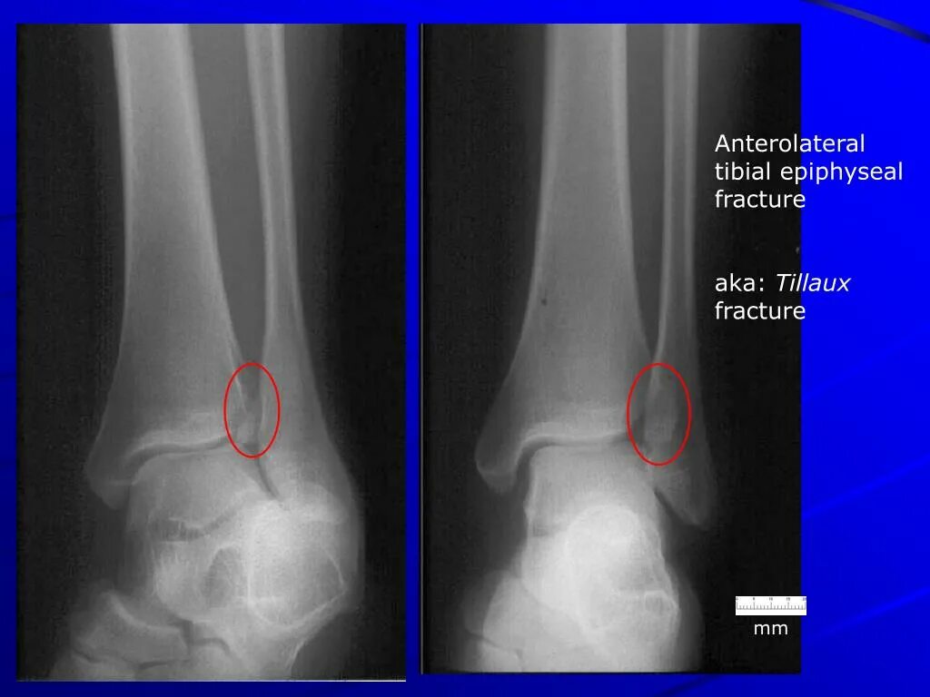 Перелом голеностопного сустава. Перелом голеностопа эпифизеолиз. Эпифизеолиз латеральной лодыжки рентген. Эпифизеолиз наружной лодыжки. Перелом эпифизеолиз наружной лодыжки.