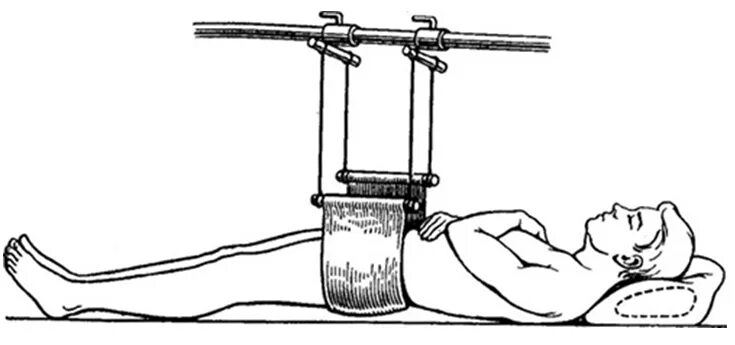 Переломы костей таза скелетное вытяжение. Перелом таза вытяжение. Перелом костей таза иммобилизация.