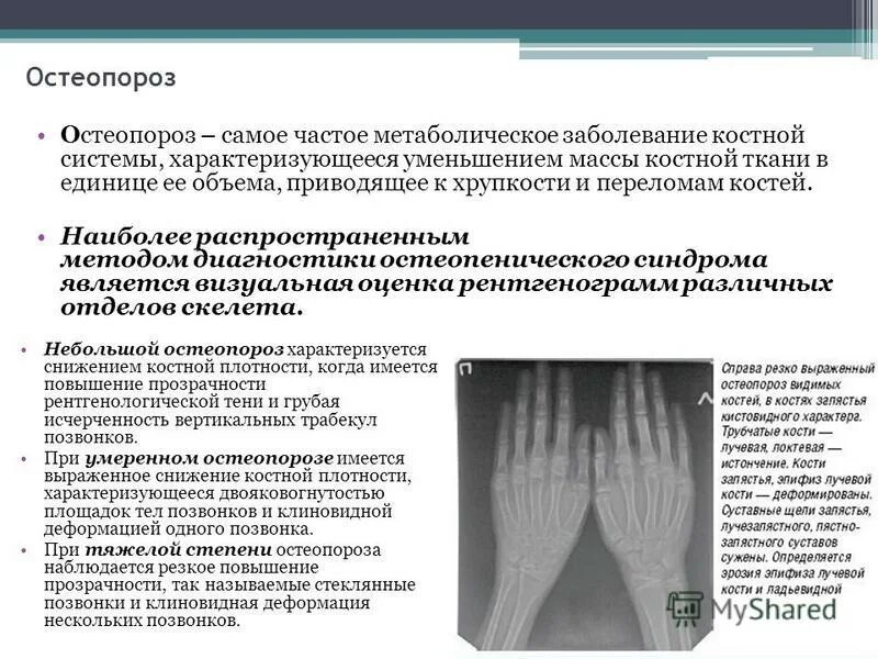 остеопороз классификация препаратов. остеопороз 4 степени. остеопороз характеризуется. остеопороз 4 степени. вторичный остеопороз классификация.