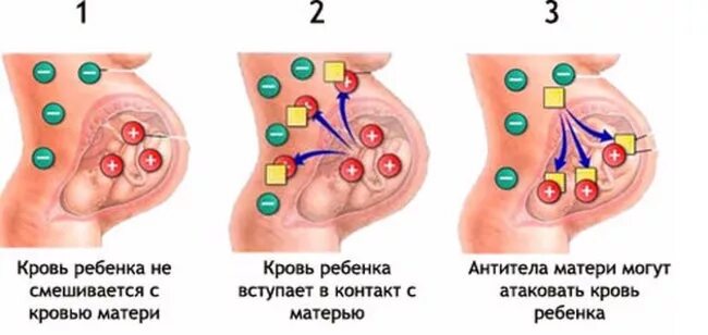 Почему кровь не смешивается. Резус-конфликт при беременности матери и плода. Беременность резус конфликт профилактика. Гемолитическая болезнь новорожденных резус фактор. Резус несовместимость и резус конфликт.