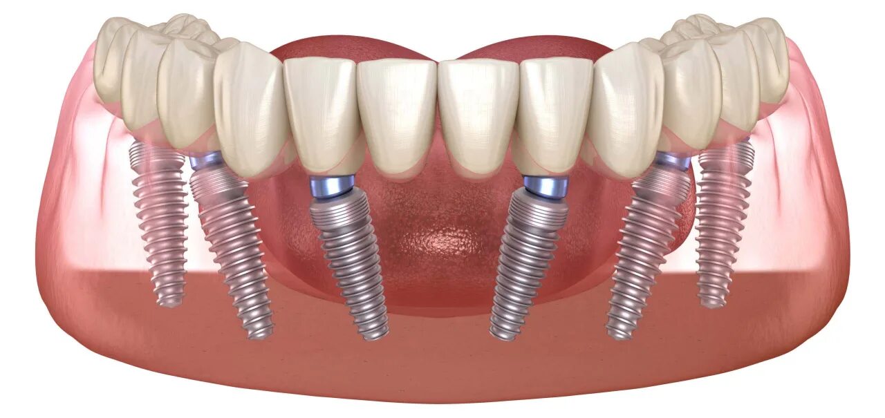 All on 6 цена. Имплантация челюсти на 6 имплантах. Дентальные имплантаты all on 6. Имплантация челюсти на 4 имплантах. Дентальные имплантаты на 6+6.