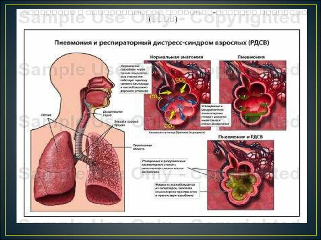 Дистресс синдром взрослых. Респираторный дистресс-синдром взрослых. Острый респираторный дистресс-синдром осложнения. Стадии развития острого респираторного дистресс-синдрома. Острый респираторный дистресс-синдром клиника.