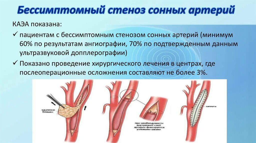 Стеноз устья вса. Асимптомный стеноз сонных артерий. Стеноз сонной артерии симптомы. Показания к операции при стенозе внутренней сонной артерии. Закупорка сонной артерии.