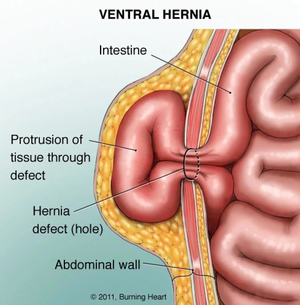 Ущемленная пупочная грыжа. Ущемленная вентральная грыжа. Ущемленная брюшная грыжа. Ущемление грыжи пупочной грыжи. Кишка с правой стороны
