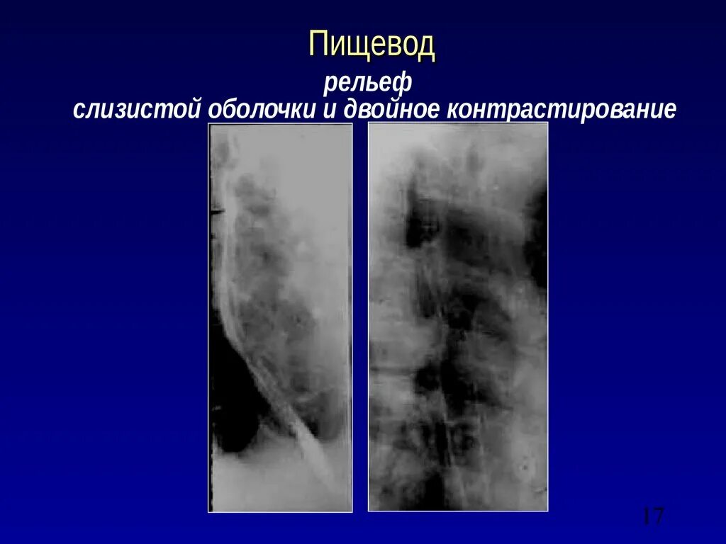 Пищевода с барием. Рентгенограмма пищевода. Контрастирование пищевода. Рельеф слизистой пищевода. Двойное контрастирование пищевода.