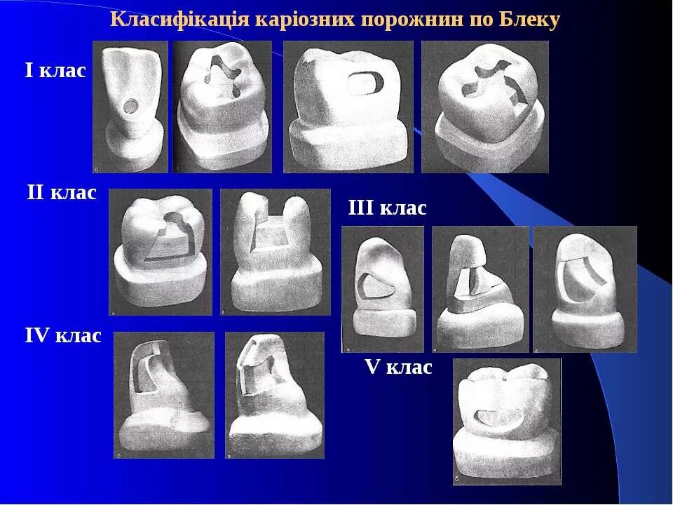 Классы полости рта. Классификация полостей по Блэку. Классиф по Блэку. Класстфикацияполостей по Блеку. Классификация кариозных полостей по Блэку.