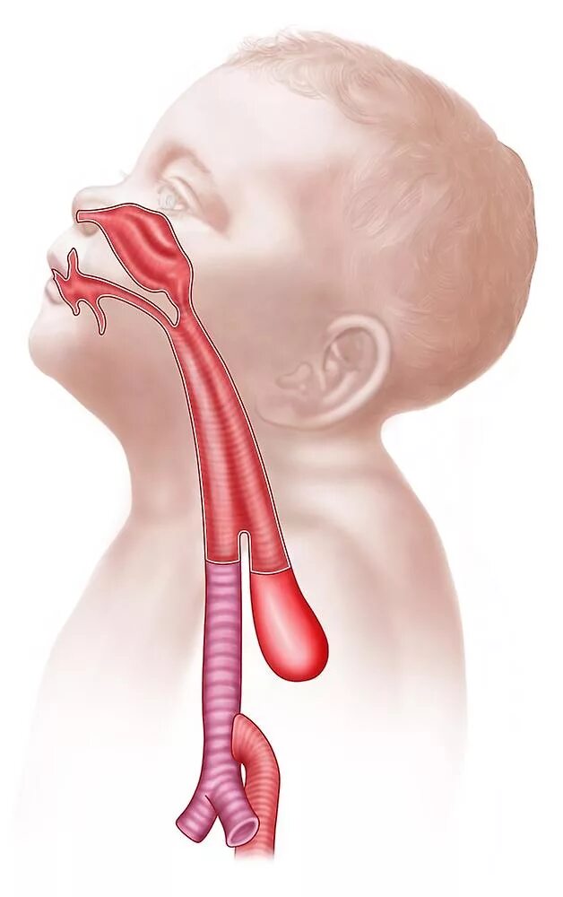 Пищевод у новорожденного