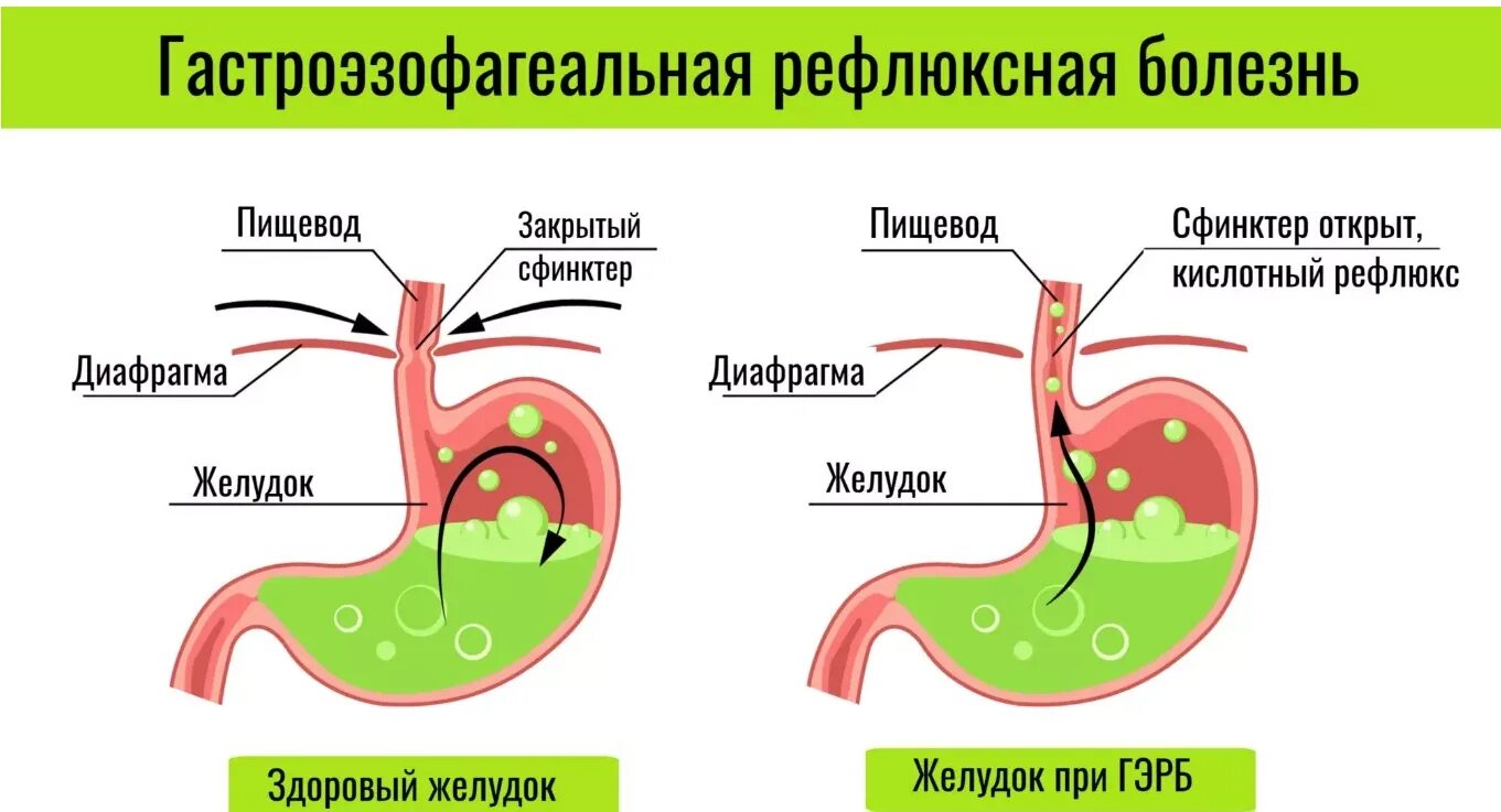 Почему изжога что делать. Гастро-эзофагальный рефлюкс симптомы. Рефлюксная болезнь желудка рефлюкс. Гастроэзофагеальной рефлюксной болезни. Рефлюксная болезнь желудка симптомы у взрослого.