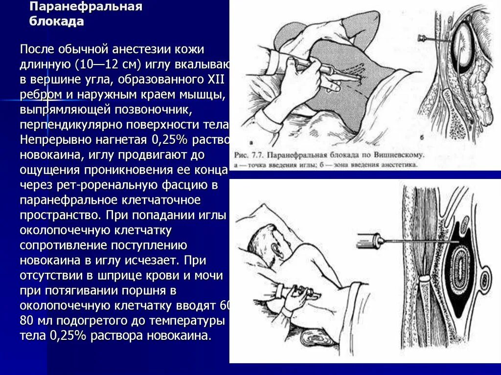 Блокада инструкция. Паранефральная блокада Вишневского. Паранефральная блокада по способу а.в.Вишневского. Техника поясничной паранефральной новокаиновой блокады. Паранефральная новокаиновая блокада.