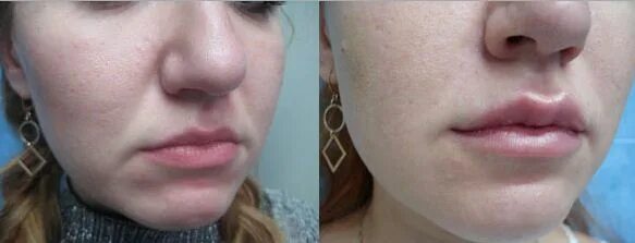 как убрать под губами. кисетные морщины ботокс. кисетные морщины деми мур. морщины над верхней губой. морщина на подбородке горизонтальная.