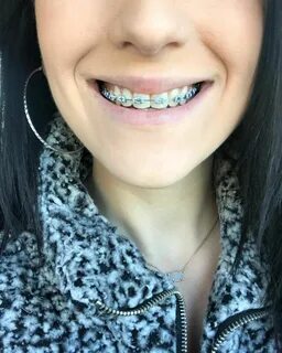 cute braces colors for summer - Olinda Cardenas.