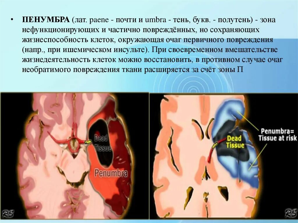 Ишемической полутени (Пенумбры). Пенумбра зона ишемической полутени.