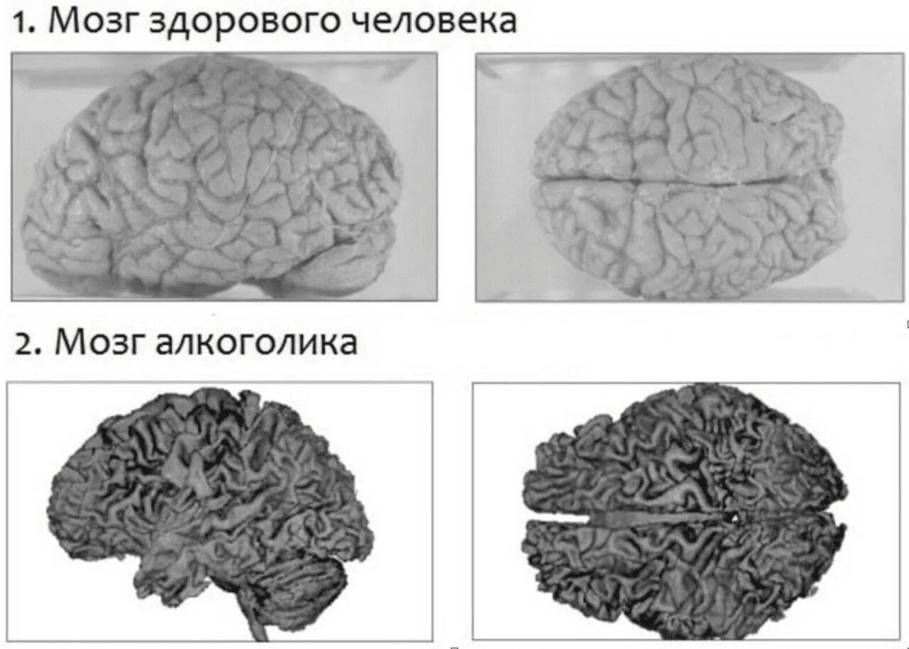 Восстановление деятельности головного мозга. Мозг здорового человека и мозг алкоголика. Мозг алкаша и здорового человека.