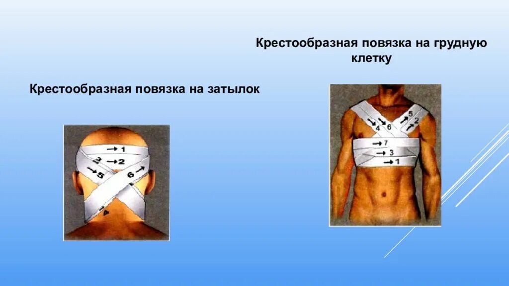 Техника наложения крестообразной повязки. Крестообразная на грудную клетку. Крестообразная повязка. Крестообразная повязка на грудь. Перевязка крестообразная на грудную клетку.