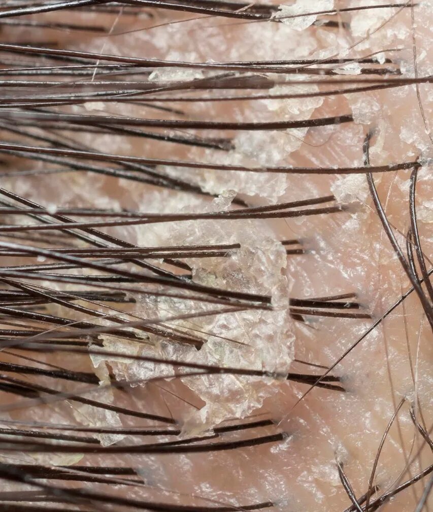 Луковица волоса под микроскопом. Корень волоса. Волосяная луковица под микроскопом.