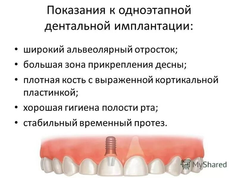 Алгоритм работы кортикального импланта. Двухэтапная методика имплантации зубов. этапы одноэтапной имплантации. одноэтапная имплантация зубов этапы. одноэтапная методика имплантации.
