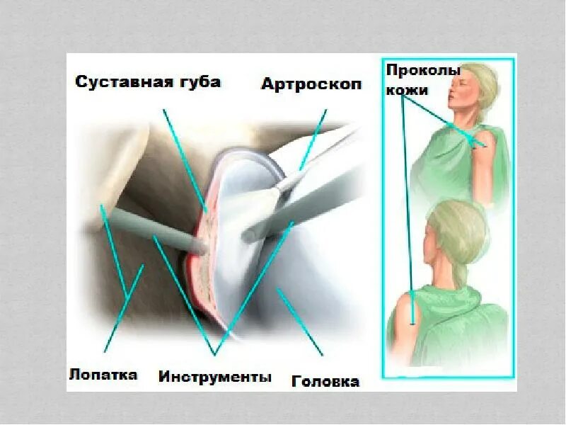 Слэп повреждение плечевого сустава. Повреждения плечевого сустава Bankart. Суставная губа плечевого сустава. Артроскопия суставной губы плечевого сустава.