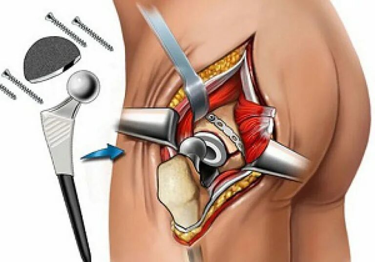 Операция по замене тазобедренного как происходит. Коленный эндопротез Stryker. Коксартроз эндопротезирование тазобедренного сустава. Тазобедренный эндопротез Зиммер. Эндопротезирование коленного и тазобедренного сустава.