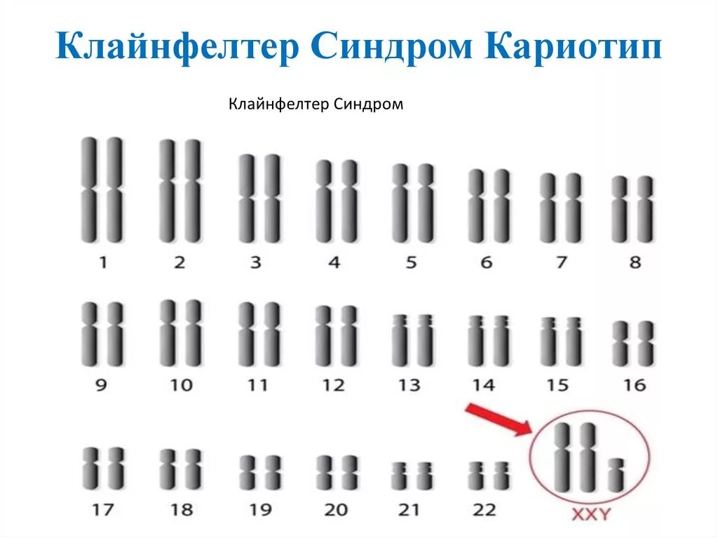 Синдром Клайнфельтера хромосомный набор. Синдром Клайнфельтера кариотип синдром. Синдром Клайнфельтера кариотип. При синдроме Клайнфелтера кариотип больного:.