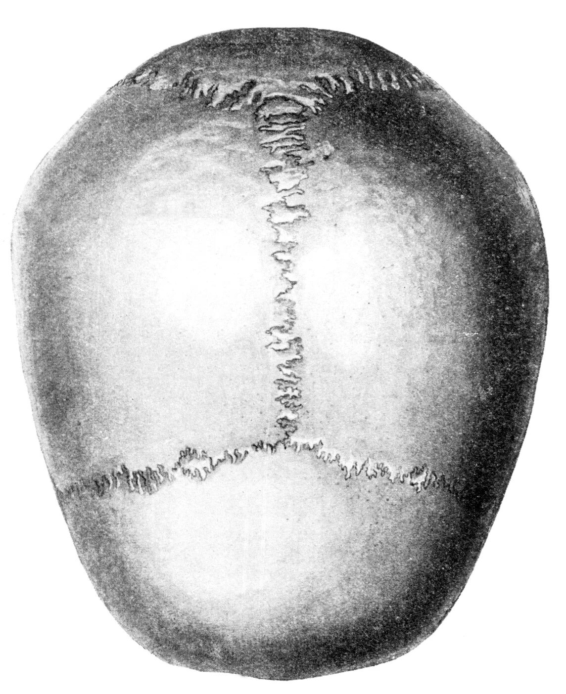 Венечный шов черепа анатомия. Кости свода черепа анатомия. Швы костей черепа анатомия. Швы свода черепа.