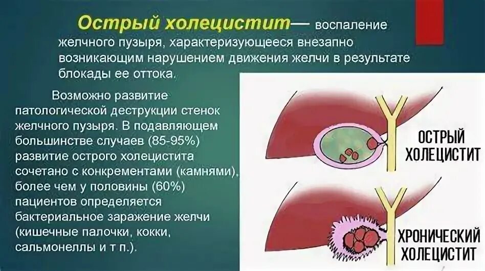 Что такое холецистит симптомы лечение. Что такое холецистит симптомы лечение