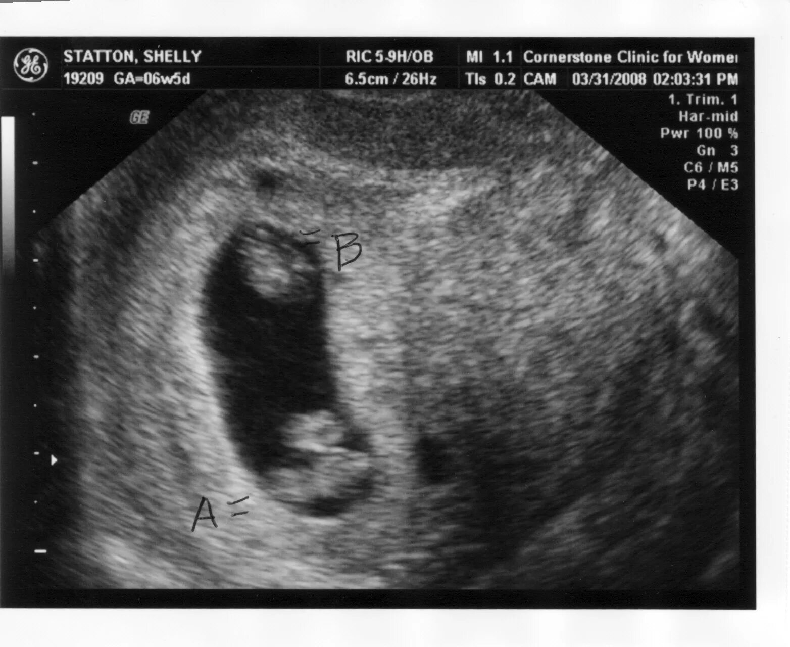 5 акушерская неделя. УЗИ двойняшек на 8 неделе беременности. УЗИ 8 недель беременности двойня. УЗИ 8 недель многоплодная беременность. Как выглядит двойня на УЗИ 8 недель.
