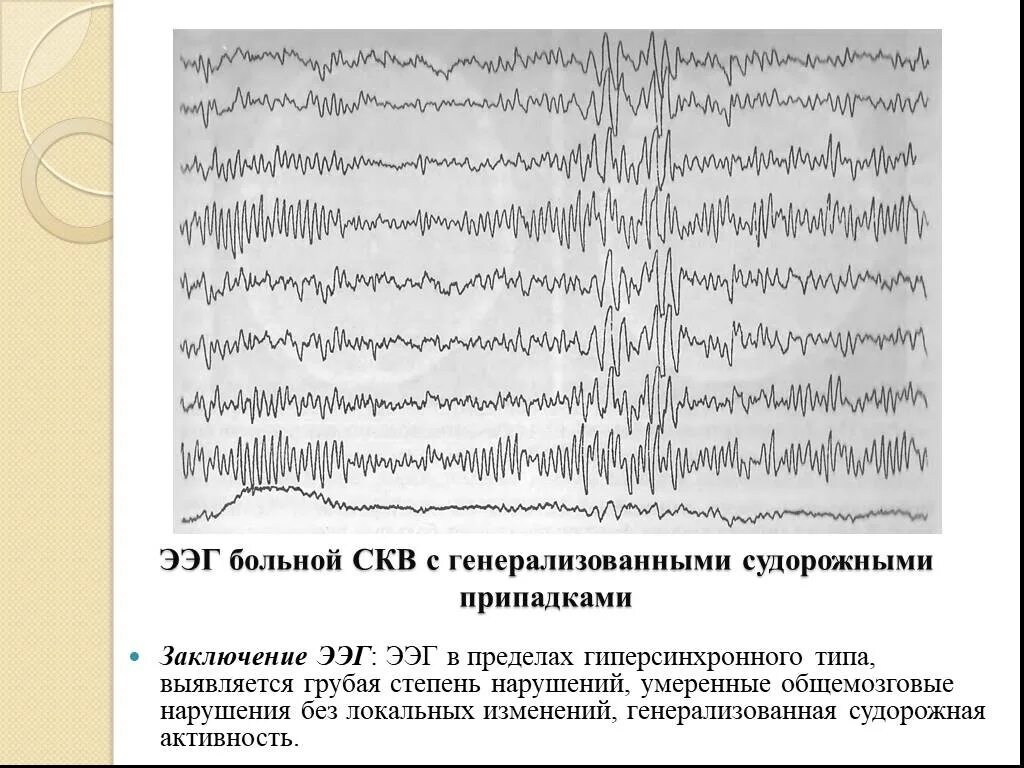 Ээг хороший результат. Энцефалограмма расшифровка норма. Генерализованная эпилепсия ЭЭГ. Заключение ЭЭГ. Электроэнцефалография норма.