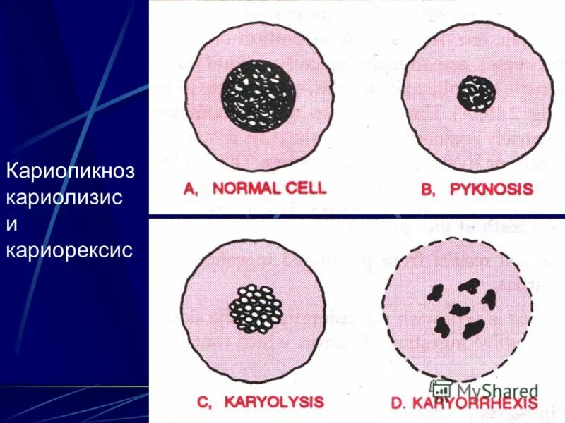 Кариопикноз это. Кариорексис кариолизис. Кариопикноз кариорексис кариолизис апоптоз. Некроз кариопикноз.