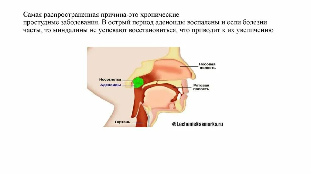 Аденоиды носоглотки 2 степени. Носоглотка воспаление аденоиды. Степени увеличения аденоидов.