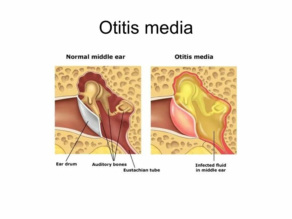Почему воспаление среднего уха. Воспаление среднего уха.
