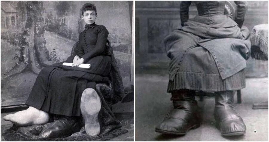 Трагические судьбы петербургских обывателей. Фанни Миллс, женщина с большими ногами.