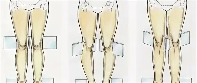 Деформация коленного сустава у детей. Варусная деформация тазобедренного сустава. Варусная деформация коленных суставов артроз. ЛФК при вальгусной деформации коленных суставов у детей. Варочная деформация тазобедренной сустав.