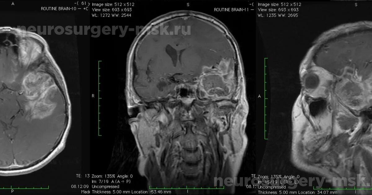 Глиобластома височной доли. Глиобластома височной доли головного мозга. Глиобластома левой теменной доли. Глиобластома ранняя стадия. Симптомы глиобластомы головного