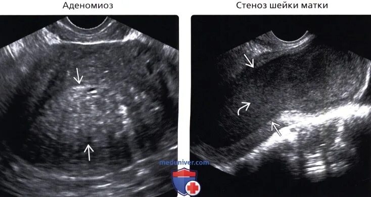 Матка увеличена до 6 недель. Увеличение матки при аденомиозе. Аденомиоз задней стенки матки что такое.
