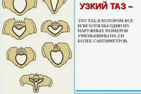 Узкий таз это