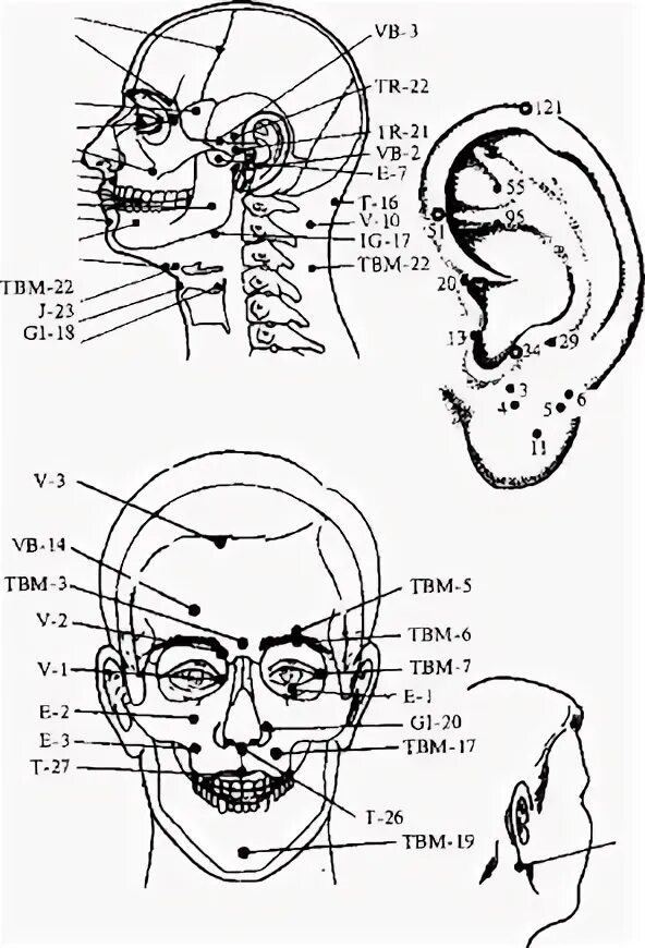 Иглоукалывание лицевой нерв. Акупунктура тройничный нерв. Иглотерапия при тройничном нерве. Иглоукалывание невралгии тройничного нерва. Невралгия тройничного нерва акупунктура.